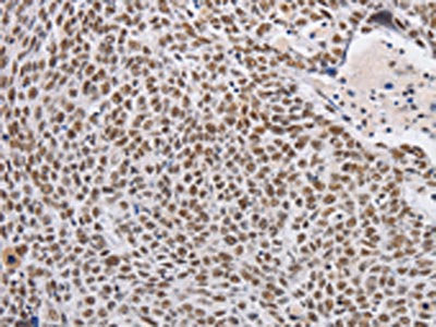 The image on the left is immunohistochemistry of paraffin-embedded Human lung cancer tissue using CSB-PA876114(THOC7 Antibody) at dilution 1/30, on the right is treated with fusion protein. (Original magnification: ×200)