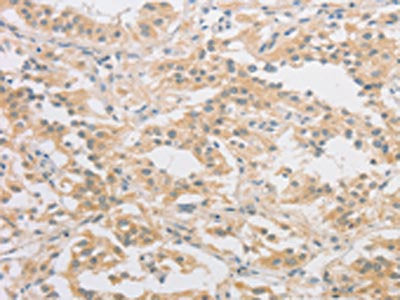 The image on the left is immunohistochemistry of paraffin-embedded Human thyroid cancer tissue using CSB-PA876212(HIPK4 Antibody) at dilution 1/40, on the right is treated with fusion protein. (Original magnification: ×200)