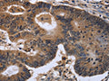 The image on the left is immunohistochemistry of paraffin-embedded Human colon cancer tissue using CSB-PA876229(FGF21 Antibody) at dilution 1/40, on the right is treated with fusion protein. (Original magnification: ×200)