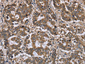The image on the left is immunohistochemistry of paraffin-embedded Human liver cancer tissue using CSB-PA876389(FGL2 Antibody) at dilution 1/20, on the right is treated with fusion protein. (Original magnification: ×200)