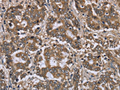 The image on the left is immunohistochemistry of paraffin-embedded Human liver cancer tissue using CSB-PA876389(FGL2 Antibody) at dilution 1/20, on the right is treated with fusion protein. (Original magnification: ×200)