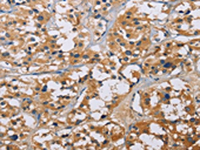 The image on the left is immunohistochemistry of paraffin-embedded Human thyroid cancer tissue using CSB-PA876464(NME5 Antibody) at dilution 1/50, on the right is treated with fusion protein. (Original magnification: ×200)