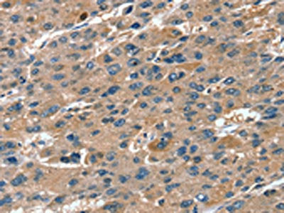 The image on the left is immunohistochemistry of paraffin-embedded Human liver cancer tissue using CSB-PA876467(RNF7 Antibody) at dilution 1/20, on the right is treated with fusion protein. (Original magnification: ×200)