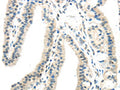 The image on the left is immunohistochemistry of paraffin-embedded Human thyroid cancer tissue using CSB-PA877335(IL12A Antibody) at dilution 1/20, on the right is treated with synthetic peptide. (Original magnification: ×200)