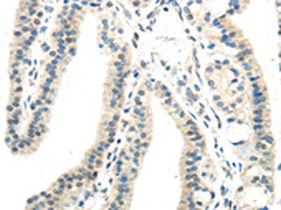 The image on the left is immunohistochemistry of paraffin-embedded Human thyroid cancer tissue using CSB-PA877335(IL12A Antibody) at dilution 1/20, on the right is treated with synthetic peptide. (Original magnification: ×200)