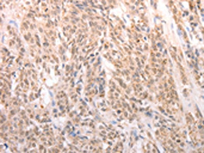 The image on the left is immunohistochemistry of paraffin-embedded Human liver cancer tissue using CSB-PA877448(ACIN1 Antibody) at dilution 1/80, on the right is treated with synthetic peptide. (Original magnification: ×200)