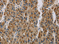 The image is immunohistochemistry of paraffin-embedded Human liver cancer tissue using CSB-PA877526(LOXL4 Antibody) at dilution 1/20. (Original magnification: ×200)