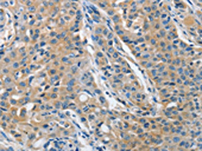 The image on the left is immunohistochemistry of paraffin-embedded Human lung cancer tissue using CSB-PA877550(TNFSF13 Antibody) at dilution 1/30, on the right is treated with fusion protein. (Original magnification: ×200)