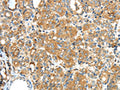 The image on the left is immunohistochemistry of paraffin-embedded Human thyroid cancer tissue using CSB-PA877573(F2 Antibody) at dilution 1/35, on the right is treated with synthetic peptide. (Original magnification: ×200)