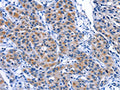 The image on the left is immunohistochemistry of paraffin-embedded Human lung cancer tissue using CSB-PA877584(MYH1 Antibody) at dilution 1/30, on the right is treated with fusion protein. (Original magnification: ×200)