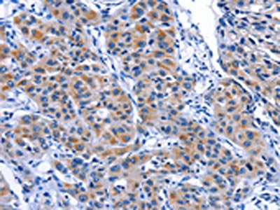The image on the left is immunohistochemistry of paraffin-embedded Human lung cancer tissue using CSB-PA877584(MYH1 Antibody) at dilution 1/30, on the right is treated with fusion protein. (Original magnification: ×200)