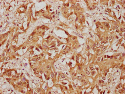 IHC image of CSB-PA878959LA01HU diluted at 1:100 and staining in paraffin-embedded human liver cancer performed on a Leica BondTM system. After dewaxing and hydration, antigen retrieval was mediated by high pressure in a citrate buffer (pH 6.0). Section was blocked with 10% normal goat serum 30min at RT. Then primary antibody (1% BSA) was incubated at 4°C overnight. The primary is detected by a biotinylated secondary antibody and visualized using an HRP conjugated SP system.