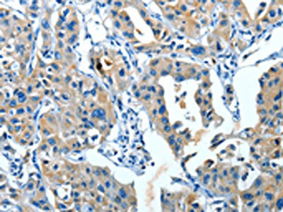 The image on the left is immunohistochemistry of paraffin-embedded Human lung cancer tissue using CSB-PA879441(SERPINA3 Antibody) at dilution 1/35, on the right is treated with fusion protein. (Original magnification: ×200)