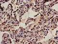Immunohistochemistry analysis of human lung cancer using CSB-PA880933LA01HU at dilution of 1:100