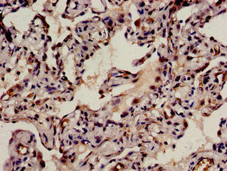 Immunohistochemistry analysis of human lung cancer using CSB-PA880933LA01HU at dilution of 1:100