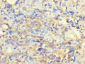 Immunohistochemistry of paraffin-embedded human gastric cancer using CSB-PA882062LA01HU at dilution of 1:100