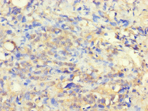Immunohistochemistry of paraffin-embedded human gastric cancer using CSB-PA882062LA01HU at dilution of 1:100