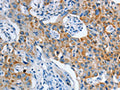 The image on the left is immunohistochemistry of paraffin-embedded Human lung cancer tissue using CSB-PA883226(ASL Antibody) at dilution 1/35, on the right is treated with fusion protein. (Original magnification: ×200)