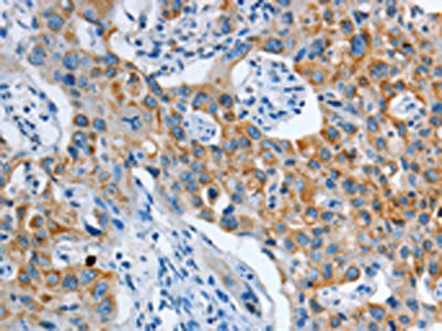 The image on the left is immunohistochemistry of paraffin-embedded Human lung cancer tissue using CSB-PA883226(ASL Antibody) at dilution 1/35, on the right is treated with fusion protein. (Original magnification: ×200)