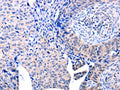 The image on the left is immunohistochemistry of paraffin-embedded Human cervical cancer tissue using CSB-PA883300(ACAD10 Antibody) at dilution 1/10, on the right is treated with fusion protein. (Original magnification: ×200)