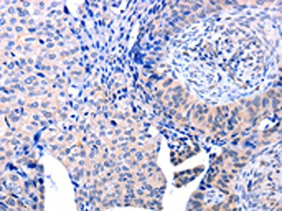 The image on the left is immunohistochemistry of paraffin-embedded Human cervical cancer tissue using CSB-PA883300(ACAD10 Antibody) at dilution 1/10, on the right is treated with fusion protein. (Original magnification: ×200)