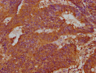 IHC image of CSB-PA883436LA01HU diluted at 1:100 and staining in paraffin-embedded human colon cancer performed on a Leica BondTM system. After dewaxing and hydration, antigen retrieval was mediated by high pressure in a citrate buffer (pH 6.0). Section was blocked with 10% normal goat serum 30min at RT. Then primary antibody (1% BSA) was incubated at 4°C overnight. The primary is detected by a biotinylated secondary antibody and visualized using an HRP conjugated SP system.