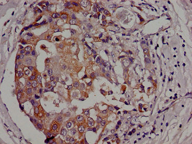 Immunohistochemistry of paraffin-embedded human breast cancer using CSB-PA883438LA01HU at dilution of 1:100