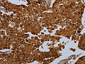 The image on the left is immunohistochemistry of paraffin-embedded Human prostate cancer tissue using CSB-PA886215(ENTPD7 Antibody) at dilution 1/60, on the right is treated with fusion protein. (Original magnification: ×200)