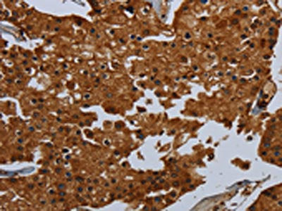 The image on the left is immunohistochemistry of paraffin-embedded Human prostate cancer tissue using CSB-PA886215(ENTPD7 Antibody) at dilution 1/60, on the right is treated with fusion protein. (Original magnification: ×200)