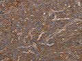 The image on the left is immunohistochemistry of paraffin-embedded Human ovarian cancer tissue using CSB-PA886231(GDF2 Antibody) at dilution 1/40, on the right is treated with synthetic peptide. (Original magnification: ×200)