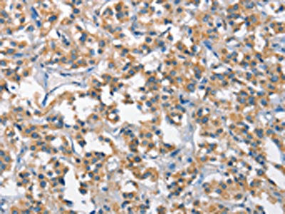 The image on the left is immunohistochemistry of paraffin-embedded Human thyroid cancer tissue using CSB-PA886284(SCARB1 Antibody) at dilution 1/65, on the right is treated with fusion protein. (Original magnification: ×200)