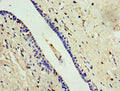 Immunohistochemistry of paraffin-embedded human breast cancer using CSB-PA887118ESR2HU at dilution of 1:100