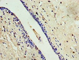 Immunohistochemistry of paraffin-embedded human breast cancer using CSB-PA887118ESR2HU at dilution of 1:100