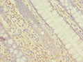 Immunohistochemistry of paraffin-embedded human colon cancer using CSB-PA889115LA01HU at dilution of 1:100