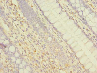 Immunohistochemistry of paraffin-embedded human colon cancer using CSB-PA889115LA01HU at dilution of 1:100