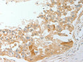 The image on the left is immunohistochemistry of paraffin-embedded Human breast cancer tissue using CSB-PA889716(ADM Antibody) at dilution 1/20, on the right is treated with synthetic peptide. (Original magnification: ×200)