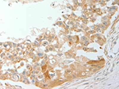 The image on the left is immunohistochemistry of paraffin-embedded Human breast cancer tissue using CSB-PA889716(ADM Antibody) at dilution 1/20, on the right is treated with synthetic peptide. (Original magnification: ×200)