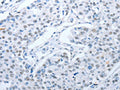 The image on the left is immunohistochemistry of paraffin-embedded Human breast cancer tissue using CSB-PA889734(ARHGEF2 Antibody) at dilution 1/30, on the right is treated with fusion protein. (Original magnification: ×200)