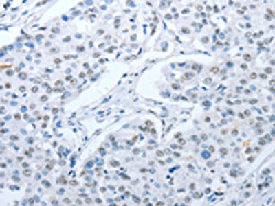 The image on the left is immunohistochemistry of paraffin-embedded Human breast cancer tissue using CSB-PA889734(ARHGEF2 Antibody) at dilution 1/30, on the right is treated with fusion protein. (Original magnification: ×200)