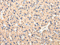 The image on the left is immunohistochemistry of paraffin-embedded Human liver cancer tissue using CSB-PA889768(CCL7 Antibody) at dilution 1/20, on the right is treated with synthetic peptide. (Original magnification: ×200)