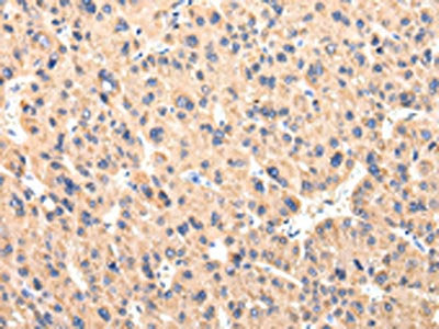 The image on the left is immunohistochemistry of paraffin-embedded Human liver cancer tissue using CSB-PA889768(CCL7 Antibody) at dilution 1/20, on the right is treated with synthetic peptide. (Original magnification: ×200)
