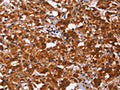 The image on the left is immunohistochemistry of paraffin-embedded Human thyroid cancer tissue using CSB-PA889866(ART5 Antibody) at dilution 1/50, on the right is treated with fusion protein. (Original magnification: ×200)