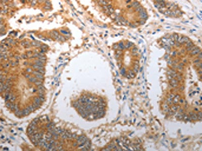 The image on the left is immunohistochemistry of paraffin-embedded Human colon cancer tissue using CSB-PA890070(NQO1 Antibody) at dilution 1/40, on the right is treated with synthetic peptide. (Original magnification: ×200)