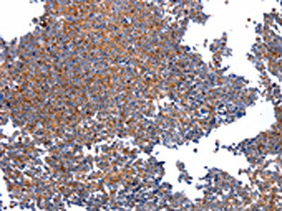 The image on the left is immunohistochemistry of paraffin-embedded Human ovarian cancer tissue using CSB-PA890968(HSPD1 Antibody) at dilution 1/30, on the right is treated with fusion protein. (Original magnification: ×200)