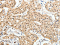 The image on the left is immunohistochemistry of paraffin-embedded Human lung cancer tissue using CSB-PA891015(PAX7 Antibody) at dilution 1/35, on the right is treated with fusion protein. (Original magnification: ×200)