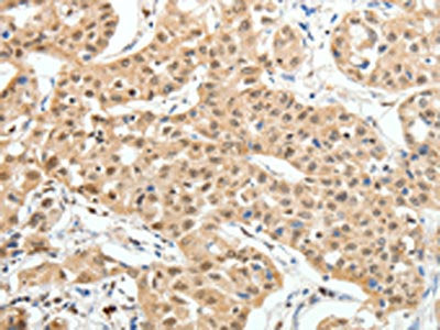 The image on the left is immunohistochemistry of paraffin-embedded Human lung cancer tissue using CSB-PA891015(PAX7 Antibody) at dilution 1/35, on the right is treated with fusion protein. (Original magnification: ×200)