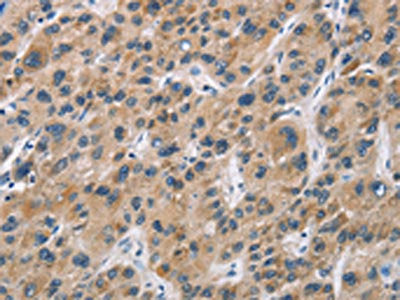 The image on the left is immunohistochemistry of paraffin-embedded Human liver cancer tissue using CSB-PA891037(CYP21A2 Antibody) at dilution 1/60, on the right is treated with fusion protein. (Original magnification: ×200)