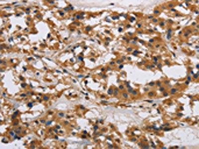 The image on the left is immunohistochemistry of paraffin-embedded Human thyroid cancer tissue using CSB-PA891383(IL17RB Antibody) at dilution 1/40, on the right is treated with synthetic peptide. (Original magnification: ×200)