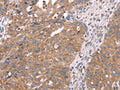 The image on the left is immunohistochemistry of paraffin-embedded Human breast cancer tissue using CSB-PA891395(APP Antibody) at dilution 1/25, on the right is treated with fusion protein. (Original magnification: ×200)