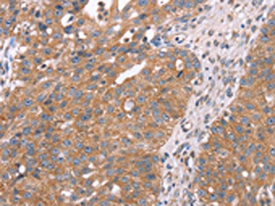 The image on the left is immunohistochemistry of paraffin-embedded Human breast cancer tissue using CSB-PA891395(APP Antibody) at dilution 1/25, on the right is treated with fusion protein. (Original magnification: ×200)